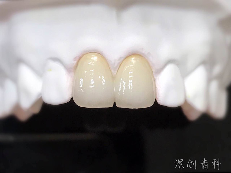 美容全瓷修复2