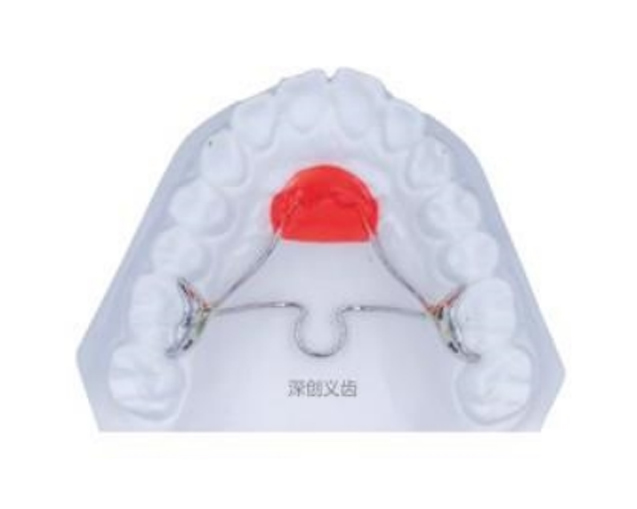 Lansi palatal arch+transverse palatal rod