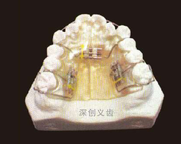 多颗螺丝扩弓器