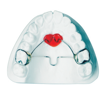 Lansi palatal arch+transverse palatal rod