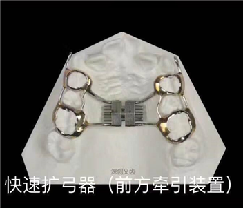 快速螺丝扩弓器