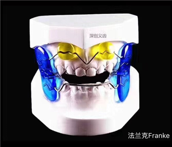 法兰克3类