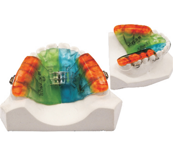 Screw expansion bow adductor