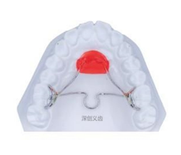 Lansi palatal arch+transverse palatal rod