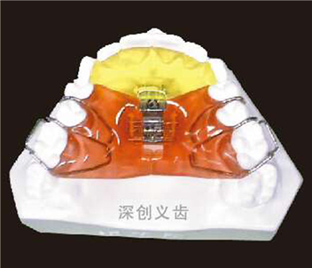 三面螺丝扩弓器