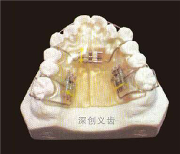 多颗螺丝扩弓器