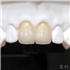 美容全瓷修复2